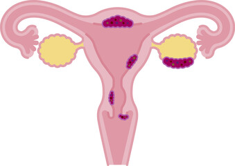 子宮がんのシンプルなイラスト・正面（イメージ素材）