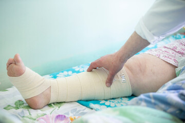 The doctor touches the patient's bandaged leg.Leg in bandages.