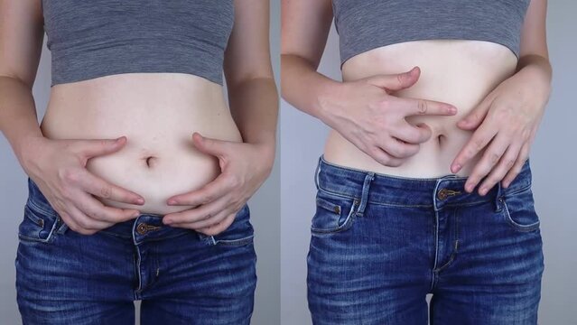 Obesity Cellulite. Folds of excess fat on woman waist. Before and after. Concept of losing weight, playing sports, checking result from diet and intense training. Result of losing weight. Liposuction