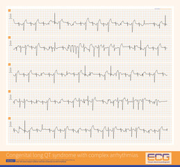 A 4-year-old boy with a clinical diagnosis of long QT syndrome. No genetic testing was done during hospitalization. The child died suddenly during follow-up.