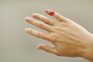 Female hand with red blood, little finger is bleeding profusely. Woman injured her little finger at...