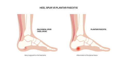 Heel spur and plantar fasciitis - 641475533