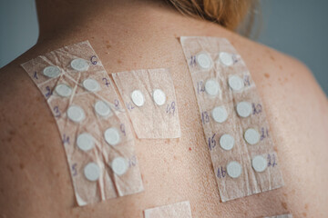 Patch test on the naked shoulder and back of a young blonde hair girl. Allergy patch testing is...