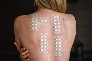 Patch test on the naked shoulder and back of a young blonde hair girl. Allergy patch testing is used to screen substances to determine the cause of an allergic skin reaction