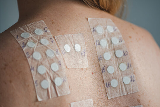 Patch test on the naked shoulder and back of a young blonde hair girl. Allergy patch testing is used to screen substances to determine the cause of an allergic skin reaction