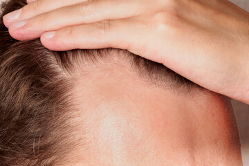 Close up of a young man holding his hair back showing clear signs of a receding hairline and hair...