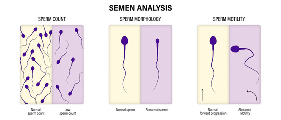 Semen analysis. Sperm count, morphology and motility. Male sperm testing. - obrazy, fototapety, plakaty