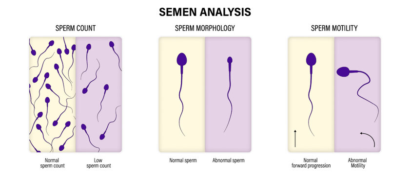 Semen analysis. Sperm count, morphology and motility. Male sperm testing.