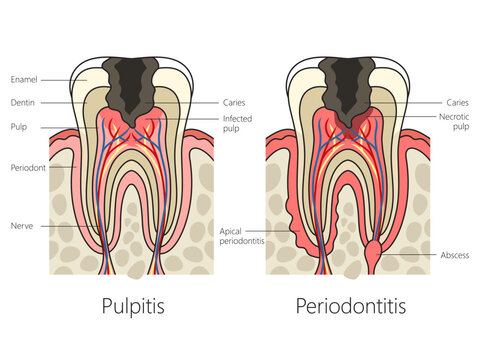 Pulpitis and periodontitis in human teeth diagram schematic vector illustration. Medical science educational illustration