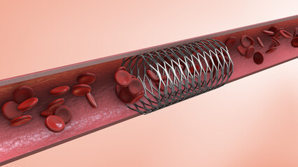 Medical concept of Coronary angioplasty stent insertion