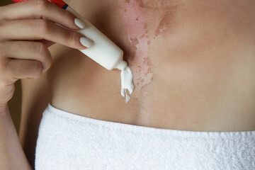 Woman applaying ointment on skin burn on her chest - obrazy, fototapety, plakaty