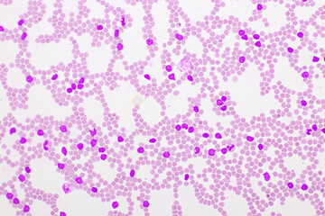 Picture of acute lymphocytic leukemia or ALL cells in blood smear, analyze by microscope, 400x