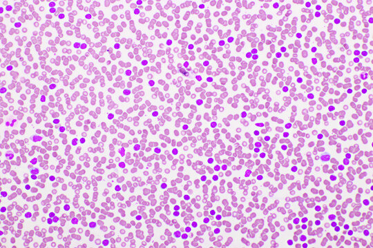 Picture of acute lymphocytic leukemia or ALL cells in blood smear, analyze by microscope, 400x