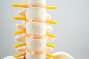 Lumbar spine displaced herniated disc fragment, spinal nerve and bone. Model for treatment medical...