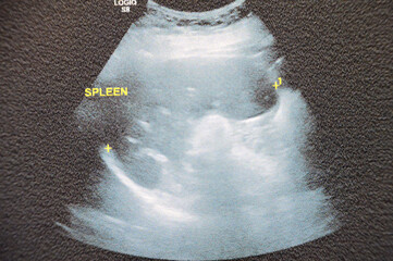 The Spleen of Normal size and texture with no focal lesion, S.V Splenic vein is not dilated,...
