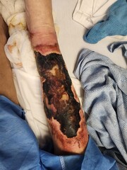 Superficial leg skin necrosis with ulcerations - gangrenous tissues - obrazy, fototapety, plakaty