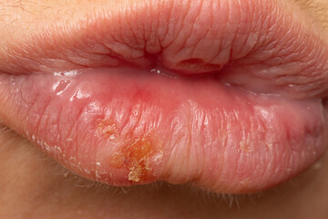 Macro of woman's lips with cold sores
