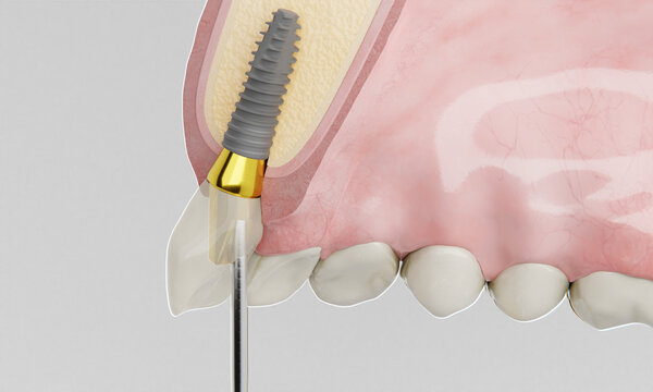 dental implant side view