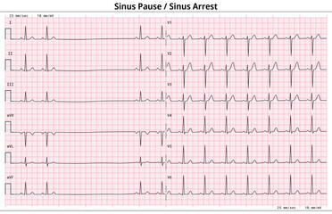Sinus Arrest - Sinus Pause - ECG Paper 12 Lead - Vector Medical Illustration