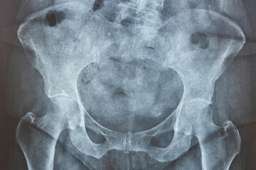 Hip xray. Human skeleton. Pelvis and femur bone. Osteoporosis