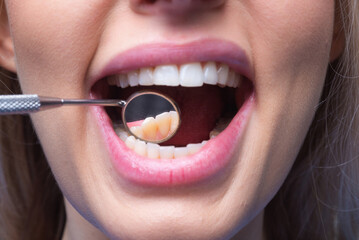 Fototapeta premium Examination of teeth with dental mirror. Dental and oral hygiene. Dental clinic. Tooth filling. Teeth examined at dentists. Healthy woman teeth and a dentist mouth mirror. Ideal teeth. Dental tools.