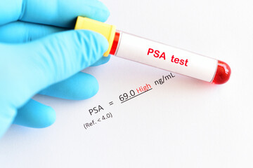 Abnormal high PSA test result with blood sample tube