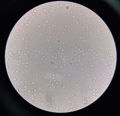 Fresh bacteria cell in urine sample.