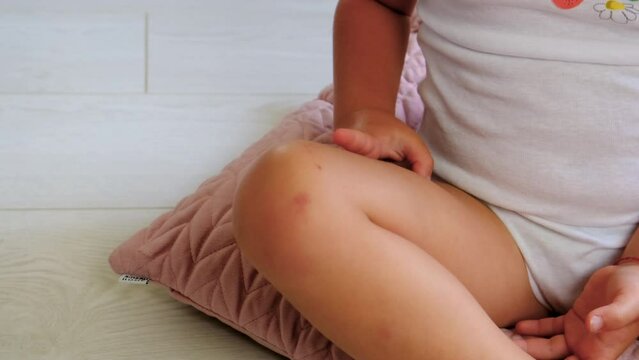 The child has a bruise on his leg. Selective focus.