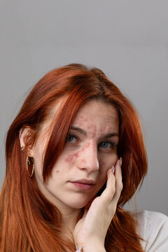 Young woman with facial skin rash. Dermatological problems