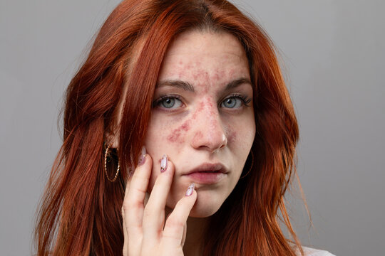 Young woman with facial skin rash. Dermatological problems