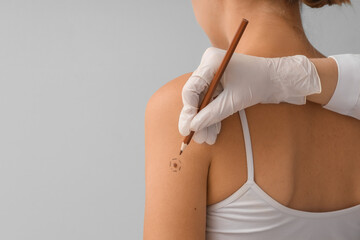 Dermatologist marking young woman's mole on light background, closeup