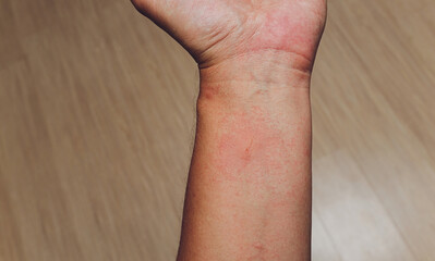 Red blisters on the hand and dermatitis, itching from allergies, skin diseases or insects,...