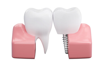 Dental implant and healthy teeth and gums