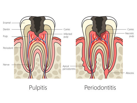 Pulpitis and periodontitis in human teeth diagram schematic raster illustration. Medical science educational illustration