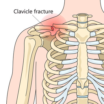 Clavicle fracture broken collarbone structure diagram schematic raster illustration. Medical science educational illustration