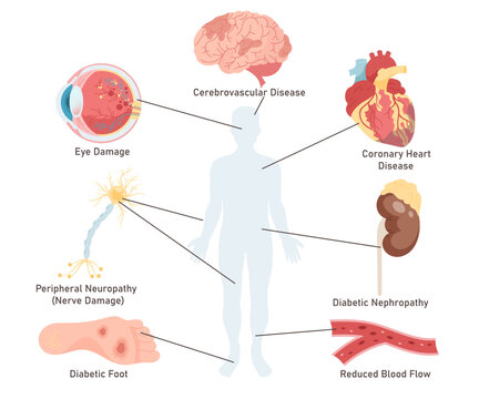 Diabetes disease complications affected human organs isolated medical set on white background