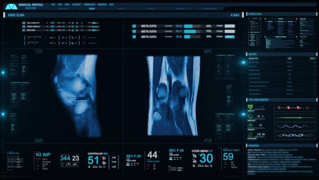 
Futuristic Technological Interface Analyzing Human Anatomy. MRI Knee Joint or Magnetic Resonance Imaging of Knee for Diagnosis Sport Trauma. Damage of Ligaments (ACL). Several Healthcare Information