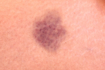 close up hematoma bruise skin from woman body.
