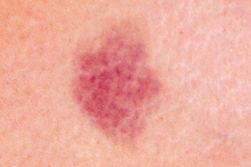 close up hematoma bruise skin from woman body. - obrazy, fototapety, plakaty