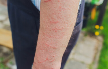 Skin allergy diseases problem, Poison tree contact dermatitis rash by pant, Female dermatology...