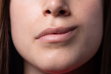 Close-up of the mouth of a girl with hemiparesis, Bell's palsy - Powered by Adobe