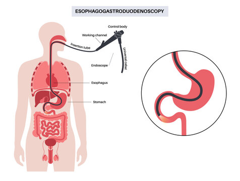 esophagogastroduodenoscopy medical procedure