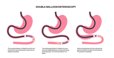 Double balloon enteroscopy