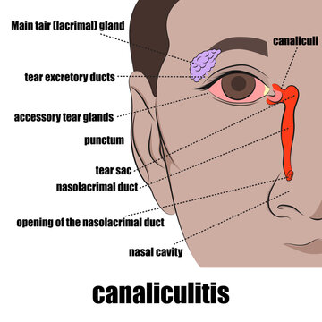 canaliculitis, inflammation of the tear duct (usually caused by an infection).