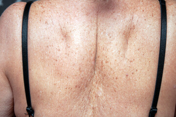 Back of a white old woman, rear view, skin