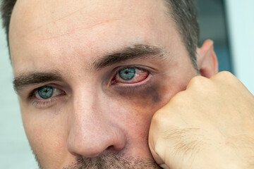 Bruises, abrasions, bruising under the eye of young man. consequences of punching a man in the eye...