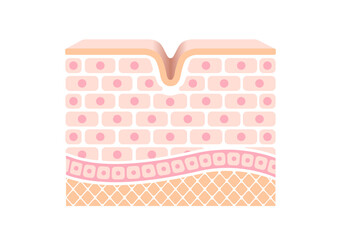 Cross section illustration of wrinkled skin