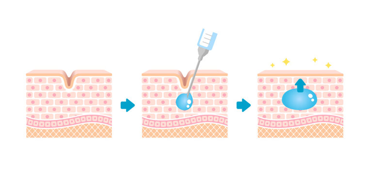 Mechanism illustration of hyaluronic acid injection (cross-sectional view of the skin)