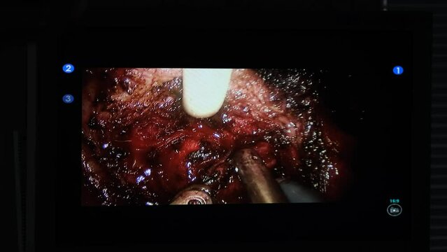 Doctors use endo-instruments and video cameras to perform surgery in the abdominal cavity of a fat man. New technologies in medicine. Laparoscopic surgery on the monitor