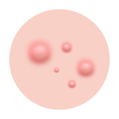 Fototapeta premium Acne skin pimple, vector illustration